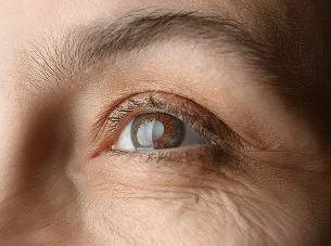 Cataract Treatment in Hamburg, NY